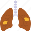 lungs disease, lungs cancer, adenocarcinoma, lung carcinoma, bronchitis 