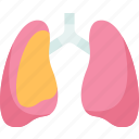 pulmonary, disease, chronic, obstructive, lungs