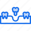 dental, surgery, care, tooth, tools, healthcare, and, medical, implants 